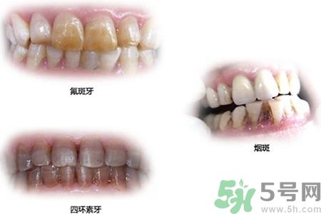 四环素牙是什么?四环素牙是怎么形成的? 四环素牙是什么?四环素牙是怎么形成的?