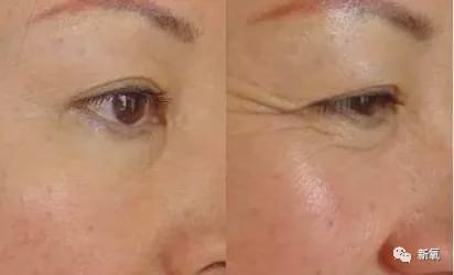 娱乐圈第一代人造美女，因为乱填充翻车了？