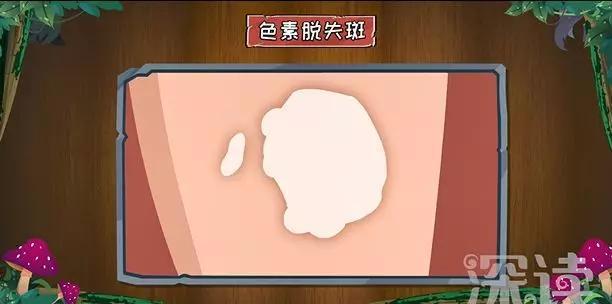身家过亿的冯小刚，为什么身患白癜风多年却一直没有治好？