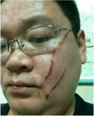 医生上电视说中国人看病太便宜, 大街上被大妈认出后动手留疤痕