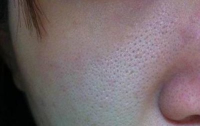 ​迷迭香加点东西一起洗脸，30天收缩粗大毛孔，一点孔都看不到