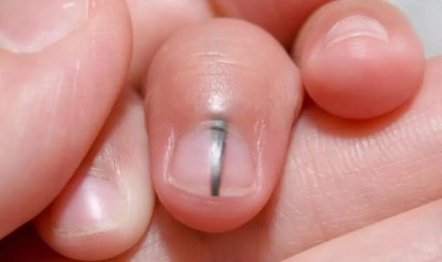 ​体内有癌，指甲先知？指甲若长成4种样子，可能是癌或疾病的信号