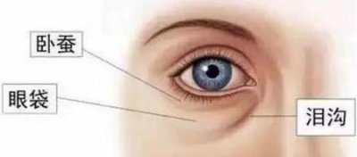 ​脸部出现泪沟了怎么办好(自体胶原蛋白填充是什么)