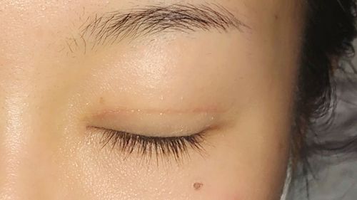 天生的双眼皮有痕迹(智慧型双眼皮真的)