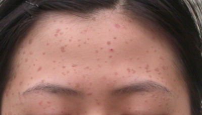 ​扁平疣是什么样子(扁平疣是什么样子图片 手背怎么办)